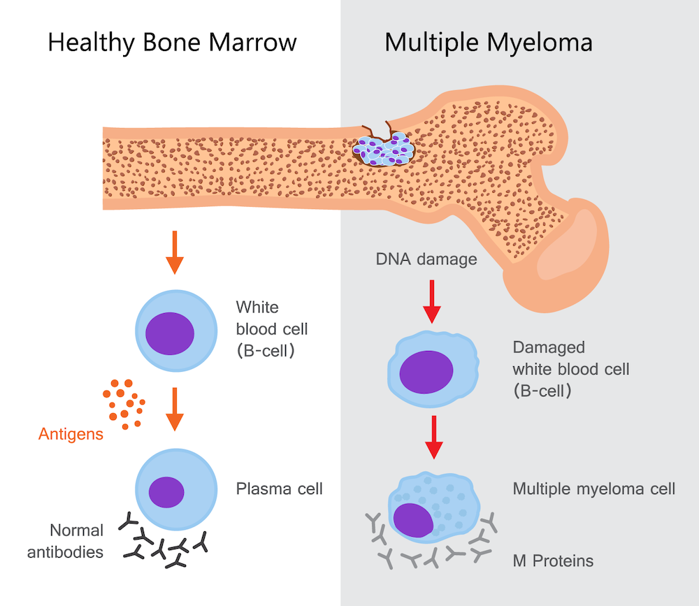 graphic illustrating myultiple myeloma cells vs regular cells