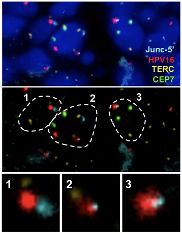Visualization of HPV16 insertion by Junc-FISH in a CIN3 sample