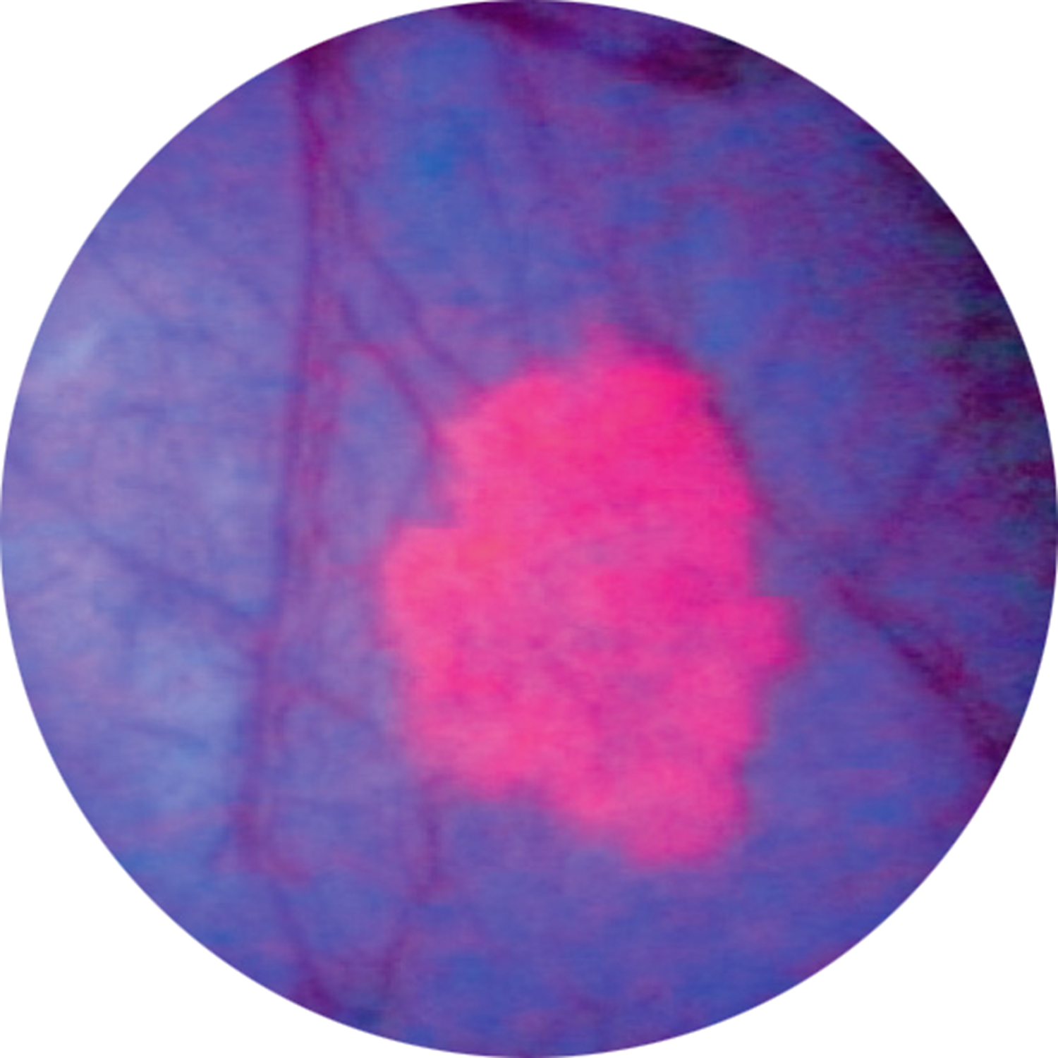 Same bladder image with blue light cystoscopy with Cysview®